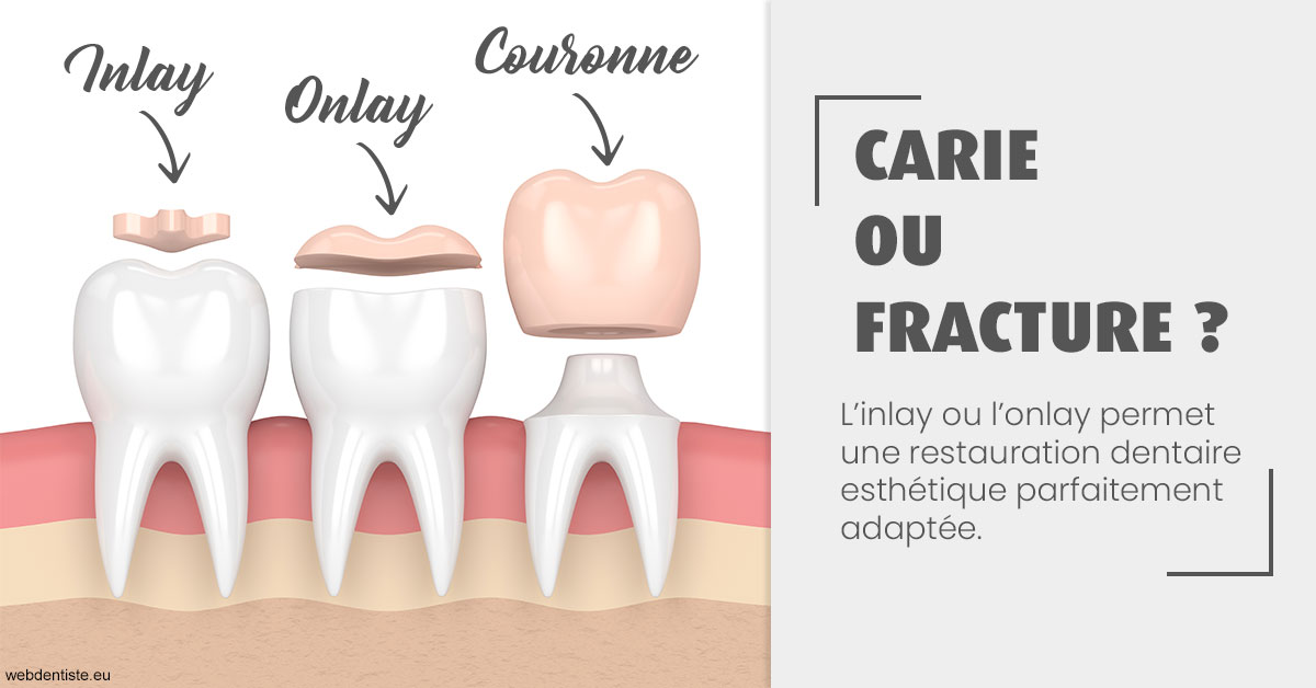https://www.chirurgien-dentiste-cannes.com/T2 2023 - Carie ou fracture 1