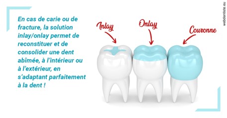 https://www.chirurgien-dentiste-cannes.com/L'INLAY ou l'ONLAY