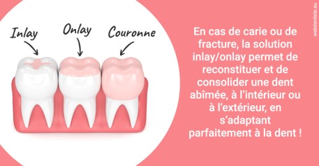 https://www.chirurgien-dentiste-cannes.com/L'INLAY ou l'ONLAY 2